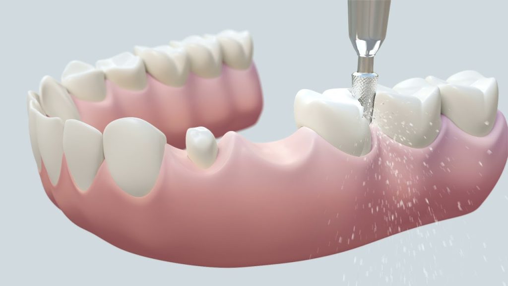 How to Care for Your Dental Crowns and Bridges