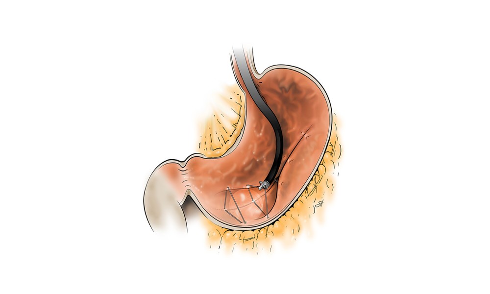 Endoscopic Sleeve Gastroplasty vs Traditional Bariatric Surgery: What Patients Should Know